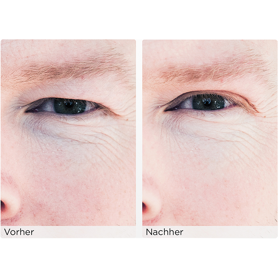 The Instant Eye Lift Without Surgery